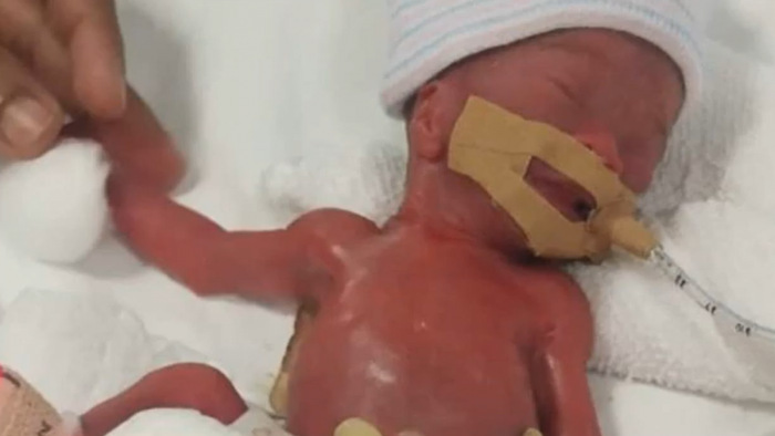 Egy év után mehet haza a világ eddigi legkisebb túlélő újszülöttje - videó