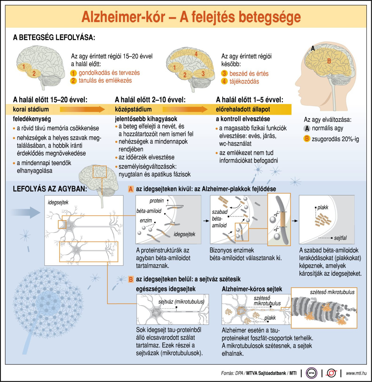 Alzheimer-kór: a felejtés betegsége. Forrás: MTI:G0462