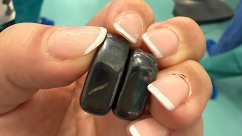 Mágneseket nyelt le egy gyerek.