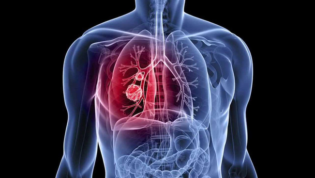 Légzés közben operálhatnak rákos tüdőt