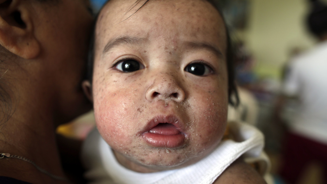 Kanyaróval fertőzött Fülöp-szigeteki gyerek egy manilai közkórházban 2019. február 7-én. A cseppfertőzéssel terjedő betegség az utóbbi időben 22 ember halálát okozta Luzon szigetén és a Visayan-szigeteken, az áldozatok többsége négyéves kor alatti gyermek.