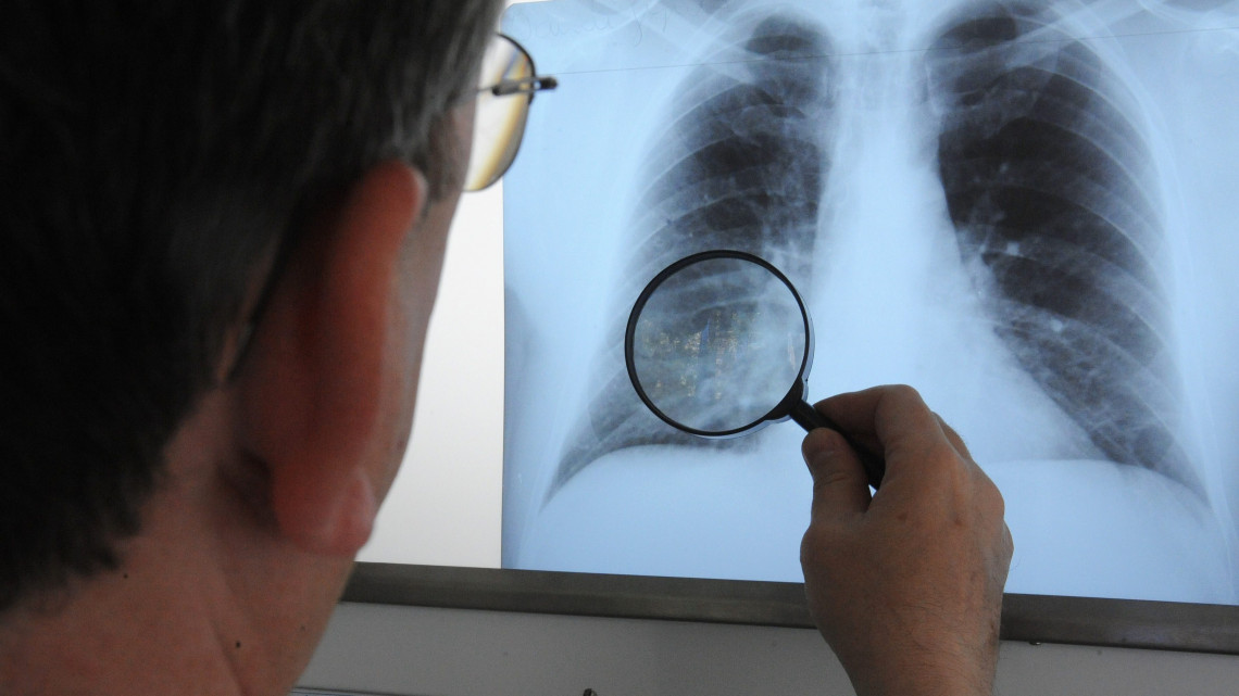 Csontos Zoltán tüdőgyógyász főorvos röntgenfelvételeket elemez. Mivel az elmúlt évben hetvenhattal emelkedett a tbs-s betegek száma a 210.000 lakosú Debrecenben és az érték meghaladja a 25 százezreléket, ezért a város tüdőgondozójának területén elrendelték a 30 év fölötti lakosság szűrését. A Hajdú-Bihar Megyei Kormányhivatal Népegészségügyi és Szakigazgatási Szerve a kötelező tüdőszűrést 2012. május 1-jéig rendelte elvégezni. A tüdőgondozóban naponta 400 behívott polgár szűrését végzik el.