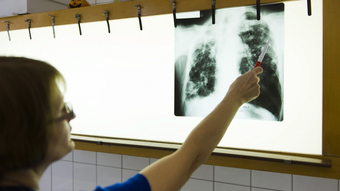 Jobbágy Veronika osztályvezető főorvos egy tbc-s beteg röntgenfelvételét értékeli 2011. március 21-én a Jósa András Oktató Kórház tüdőgondozójában, Nyíregyházán. Az Egészségügyi Világszervezet (WHO) március 24-én tartja a tuberkulózis (tbc) elleni küzdelem világnapját.