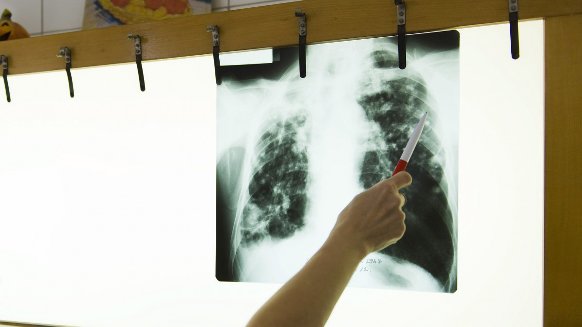 Jobbágy Veronika osztályvezető főorvos egy tbc-s beteg röntgenfelvételét értékeli 2011. március 21-én a Jósa András Oktató Kórház tüdőgondozójában, Nyíregyházán. Az Egészségügyi Világszervezet (WHO) március 24-én tartja a tuberkulózis (tbc) elleni küzdelem világnapját.