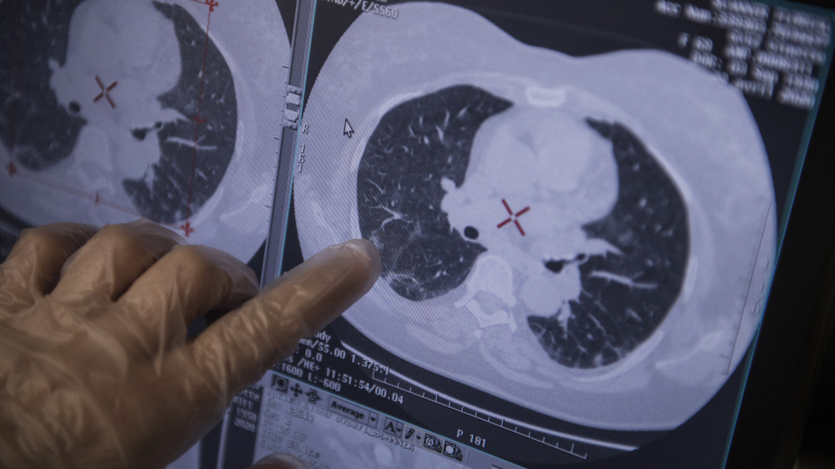 Koronavírus-fertőzés gyanújával kórházba került beteg röntgenképét nézi meg egy védőruhás dolgozó a Párizs melletti Bagnolet Floral Klinikájának elkülönítőjében 2020. április 22-én.