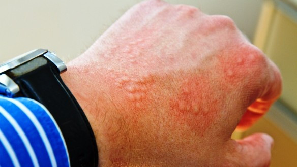 Tévhiteket oszlat el az MTA az allergia és a csalánkiütés kapcsolatáról