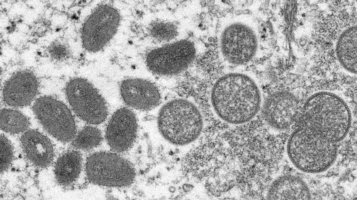 Az amerikai járványügyi és betegségmegelőzési központ, a CDC által 2022. május 19-én közreadott, 2003-ban elektronmikroszkóppal készített kép a majomhimlő virionjáról az Egyesült Államokban. A biológiai minta prérikutyából származik. 2022 májusának második felében Európa több országában vettek nyilvántartásba majomhimlővel fertőzött embereket. A hólyagos bőrkiütésekkel és lázzal járó, testnedvekkel terjedő fertőzés nyugat-afrikai eredetű, és először 1985-ben azonosították. A betegség közvetlenül terjed emlősállatról emberre, lefolyása vírustörzstől függően változik.
