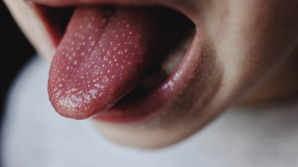 Boy with scarlet fever tongue