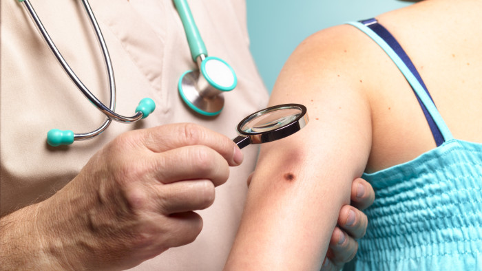 Veszélyes anyajegyek, leégés, szoláriumozás – nem is gondolná, milyen könnyen kialakulhat a bőrrák