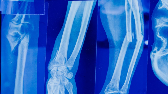 Döbbenetes magyarázatot adtak a bölcsődei dolgozók az eltört lábú kisfiú édesanyjának