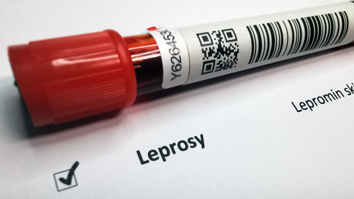 Mekkora veszély a kolozsvári lepra? A szakértő válaszol